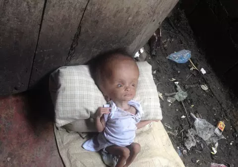 Emoționant! A adoptat o fetiță abandonată, care suferea de hidrocefalie. Cum arată acum copila | Imagini cu puternic impact emoțional