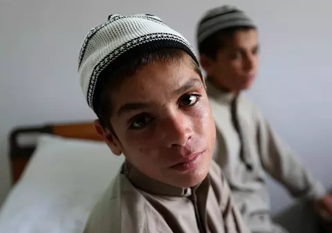 Caz bizar în Pakistan. Doi fraţi normali ziua paralizează complet noaptea. Ce spun medicii