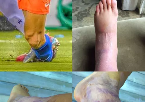 Nu e deloc ușoară viața de fotbalist! Imagini horror cu picioarele unui proaspăt câștigător al Copei America