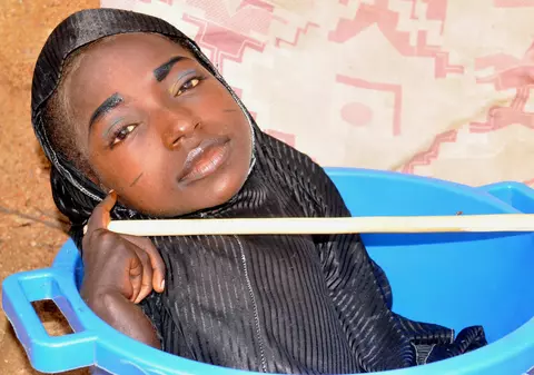 Trăiește doar într-un lighean! Viața crudă a unei tinere care suferă de o maladie rară