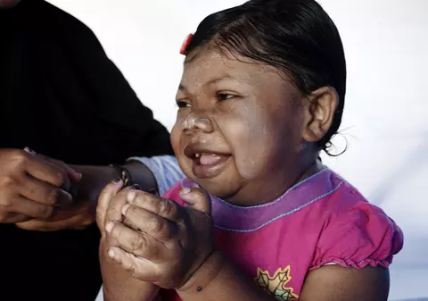 Are 24 de ani, însă arată ca și cum nu ar avea mai mult de trei ani. Boala rară de care suferă o tânără din Indonezia