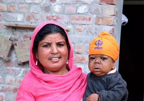 Caz medical incredibil. Un tânăr din India are 21 de ani, dar arată ca un copil de șase luni