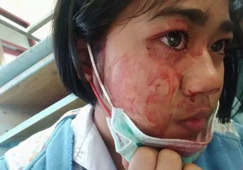 O fată de 7 ani suferă de o boală îngrozitoare: sângerează prin ochi, gură, urechi și piele