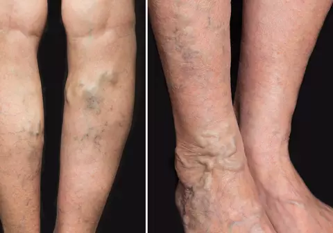 Cum să scapi de VARICE în două săptămâni? Leacul natural care face minuni