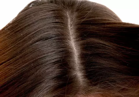 Problemele cauzate de un scalp sensibil. De ce apare mătreața