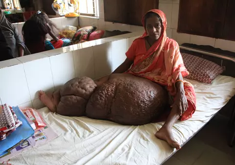 FOTO | Drama unei femei bolnave de elefantiazis. Piciorul ei a ajuns să cântărească 60 de kilograme