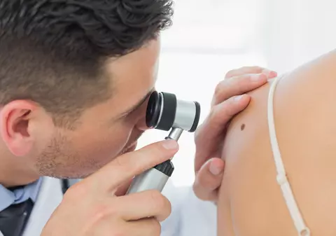 Cum îţi dai seama dacă aluniţele tale sunt cancerigene. Cum aplici regula ABCDE