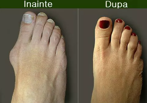 Monturile - ce sunt, de ce apar și cum pot fi tratate
