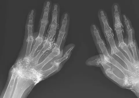 O femeie are încheieturile de la mâini cu firicele de aur. Cazul care i-a uluit pe doctori