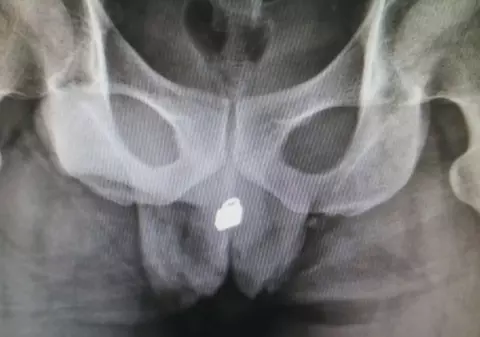 Un bărbat a ajuns la spital după ce și-a băgat un lacat prin uretră