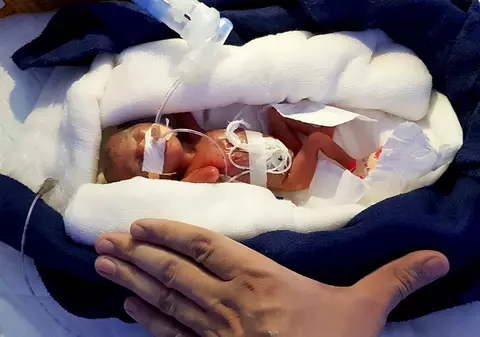 Cum arată copilul care cântărea 400 de grame la naștere și a supraviețuit