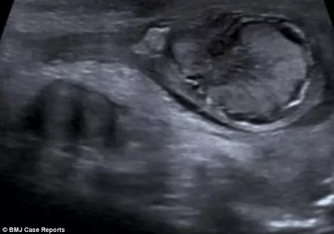 Caz medical incredibil. Unui copil i s-au răsucit testiculele ireversibil