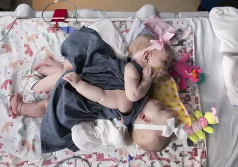 Siameze care aveau inimile lipite au supraviețuit operației de separare
