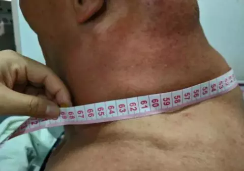 FOTO | Cum arată "Hulk", un pensionar care a consumat alcool în fiecare zi, timp de 30 de ani