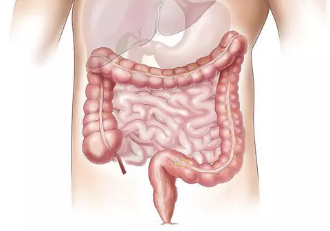 Medicul Alexandru Oproiu: Cancerul colorectal este cauzat de alimentaţia modernă, bogată în carne roşie. Vârsta la care apare boala a scăzut la 45 de ani