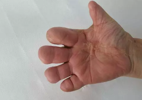 Cazul femeii din Brașov care a pierdut cinci degete, reevaluat de Casa de Pensii. Nu primea pensie de boală dintr-o „eroare”