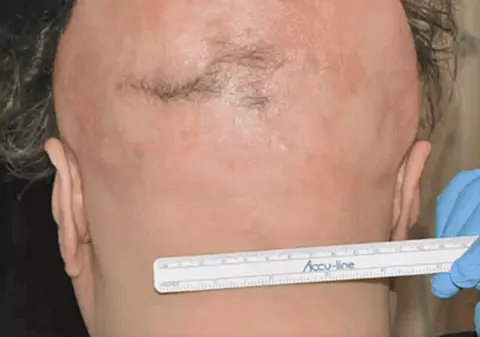 A fost descoperit un nou leac pentru oamenii care chelesc