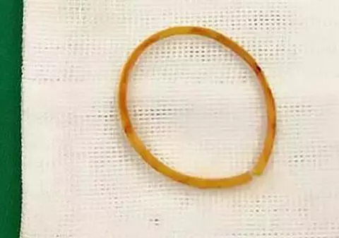 Ce a pățit o fetiță după ce a ținut prea mult timp un elastic pe braț. A fost nevoie de intervenția doctorilor