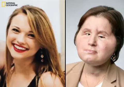 FOTO | Povestea tinerei care a făcut un transplant facial după ce s-a împușcat în încercarea de a se sinucide