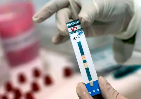 Virusul HIV, eliminat cu ajutorul transplantului de celule stem