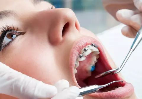 LIBERTATEA TE AJUTĂ: Aparate ortodontice pentru elevi. Cum se obține ajutorul financiar de 750 de lei