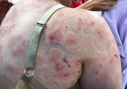 FOTO ȘOCANTE! Cum arată corpul unei femei care și-a apărat fetița cu propriul trup, în timpul unei furtuni cu grindină