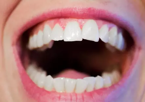 (P) Prețul unui implant dentar în București - Pune-ți în plan să-ți aranjezi dantura până la finalul anului