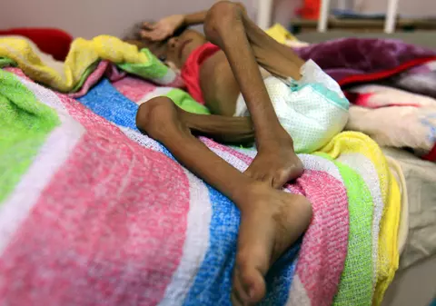 Fetița care a devenit simbolul crizei din Yemen a murit de malnutriție. Fotografia ei a șocat o lume întreagă