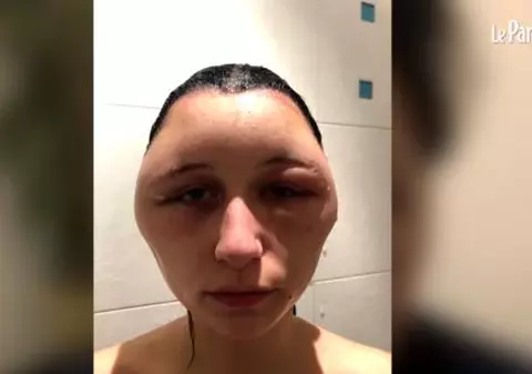 O tânără din Franța a fost desfigurată de un produs banal. Aproape toate femeile îl folosesc