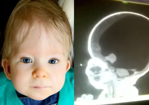 FOTO | Povestea incredibilă a băiețelului care s-a născut fără creier. Este uimitor ce a ajuns să facă la șase ani!