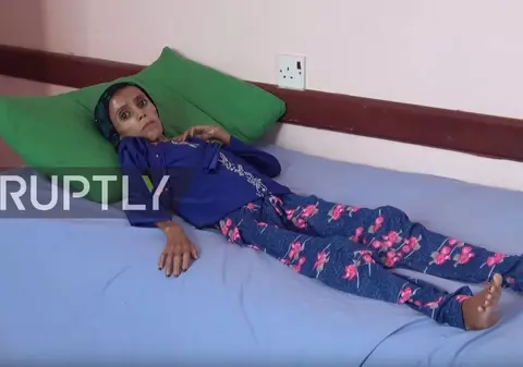 Povestea fetiței care cântărește 10 kilograme, la 12 ani. Este "piele și os" pentru că părinții nu au cu ce să o hrănească din cauza războiului / VIDEO