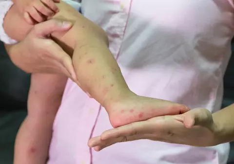 Creştere alarmantă a numărului cazurilor de rujeolă în Europa, atrage atenția OMS. Care este situația în România