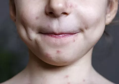 Ce a pățit o fetiță care s-a prefăcut că are varicelă pentru a nu merge la școală