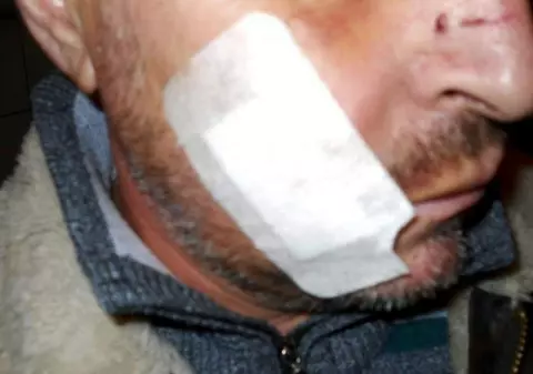 Bărbat din Vaslui, desfigurat cu o halbă de bere