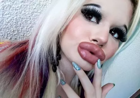 Are 22 de ani și a făcut 15 intervenții de mărire a buzelor