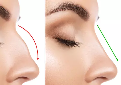 (Publicitate) Cum ii ajuta operatia de rinoplastie pe pacienti in viata lor personala si profesionala?