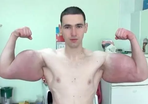 Un rus s-a visat Popeye, dar era să moară din cauza mușchilor falși. ”A blocat fluxul sanguin”. Bătut și părăsit de iubită