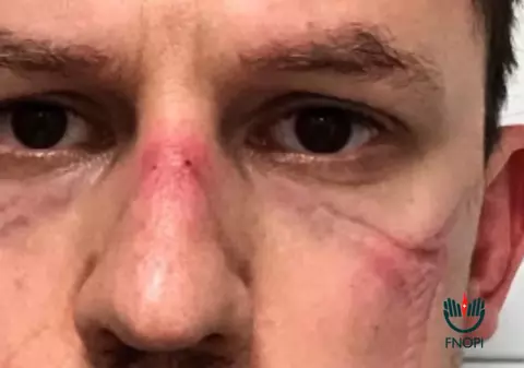 Cu cicatrici pe fețe lăsate de măști, asistenții medicali italieni fac un apel: „Suntem epuizați și suntem puțini. Nu mai e timp”