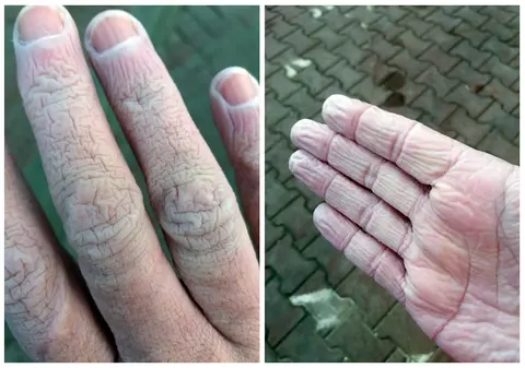 Cum arată mâinile unui cadru medical din Suceava după 12 ore de muncă