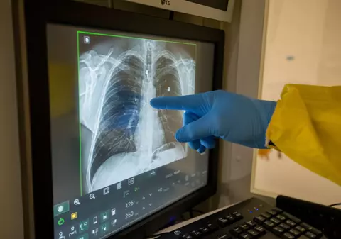 Medicii italieni anunță o ”nouă urgență sanitară”: 30% dintre pacienții COVID ar putea avea probleme respiratorii cronice