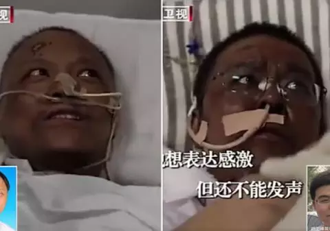 Unul dintre medicii chinezi a căror piele s-a înnegrit din cauza tratamentului pentru coronavirus a murit, celălalt s-a recuperat