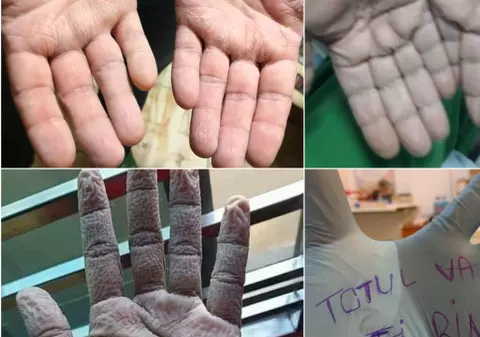 Imagini tulburătoare. Cum arată mâinile medicilor îmbrăcați în echipament anti COVID-19 ore în șir