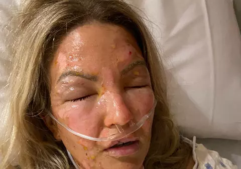 O femeie din Texas a suferit arsuri grave după ce și-a dat cu dezinfectant pe mâini și a folosit apoi o lumânare