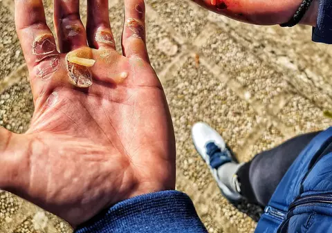Cum arată palmele unui canotor după 24 de kilometri de vâslit. „Suntem mândri de tine, Ciprian Tudosă”