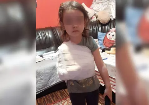 Un medic de la spitalul din Corabia e acuzat că a bandajat mâna unei fetițe cu tot cu tricou. Managerul spune că procedura a fost corectă, DSP a dat amendă