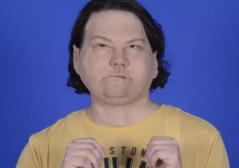 Tânărul căruia i-a explodat mașina și a fost ars aproape complet a primit o nouă față și două mâini noi, după primul transplant din lume de acest fel reușit