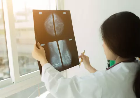 Cancerul de sân, cel mai răspândit tip de cancer din lume, depăşindu-l pe cel pulmonar