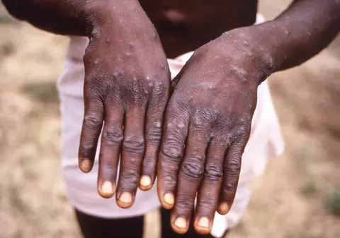 Ce trebuie să știm despre variola maimuței (mpox). Explicațiile medicului Adrian Marinescu