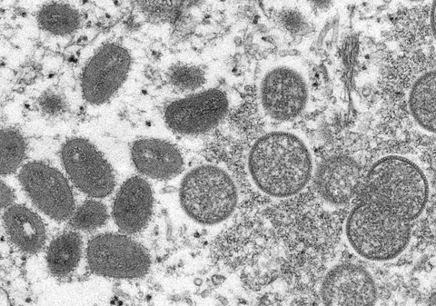 Expert OMS: Variola maimuței s-a răspândit probabil prin contact sexual la două petreceri de amploare din Europa