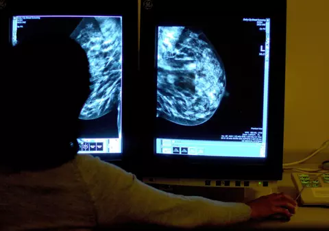 O formă agresivă de cancer de sân afectează mai mult femeile de culoare - Studiu